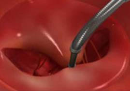 Mitral edge-to-edge repair — clip in place