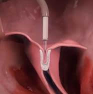 Mitral edge-to-edge repair — leaflet capture